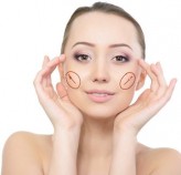 Naso-labial folds with PDO Threads Lift Naso-labial folds with PDO Threads Lift