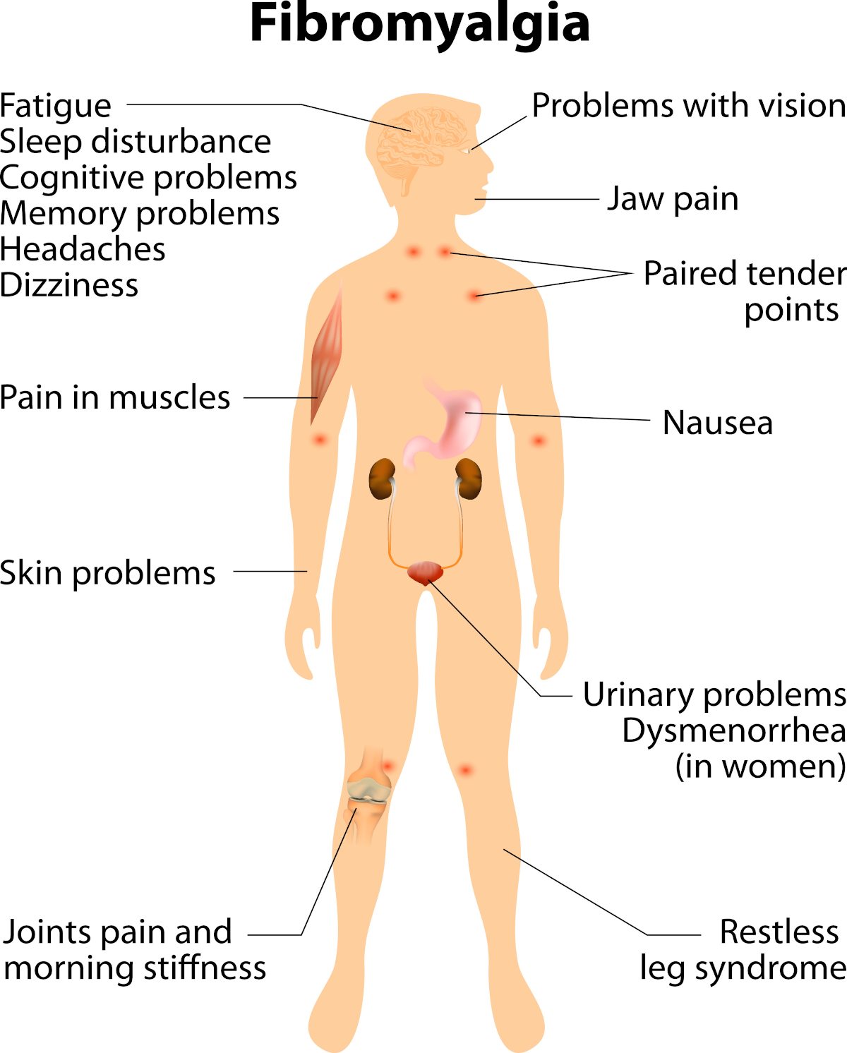 THE DIFFICULTIES IN DIAGNOSING AND TREATING FIBROMYALGIA disease