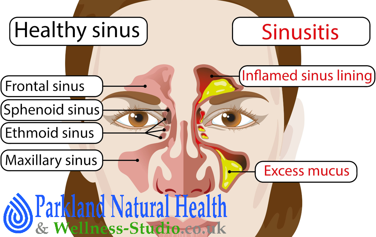 GENYANTRITIS. Stop up the rheum by frigorific nasal drops