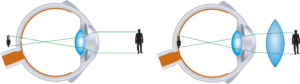 Vision is usually impaired only in case of moderate or severe farsightedness