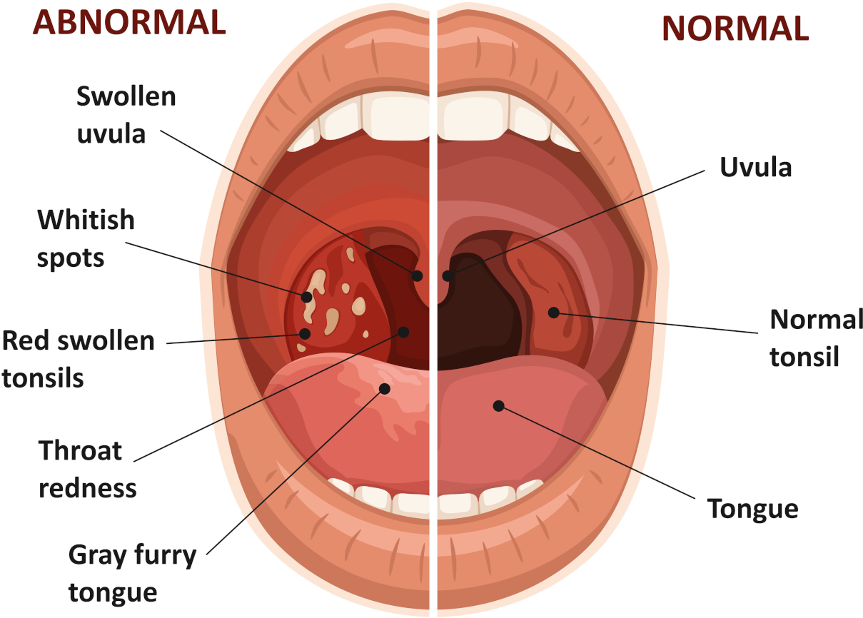 severe tonsil infection