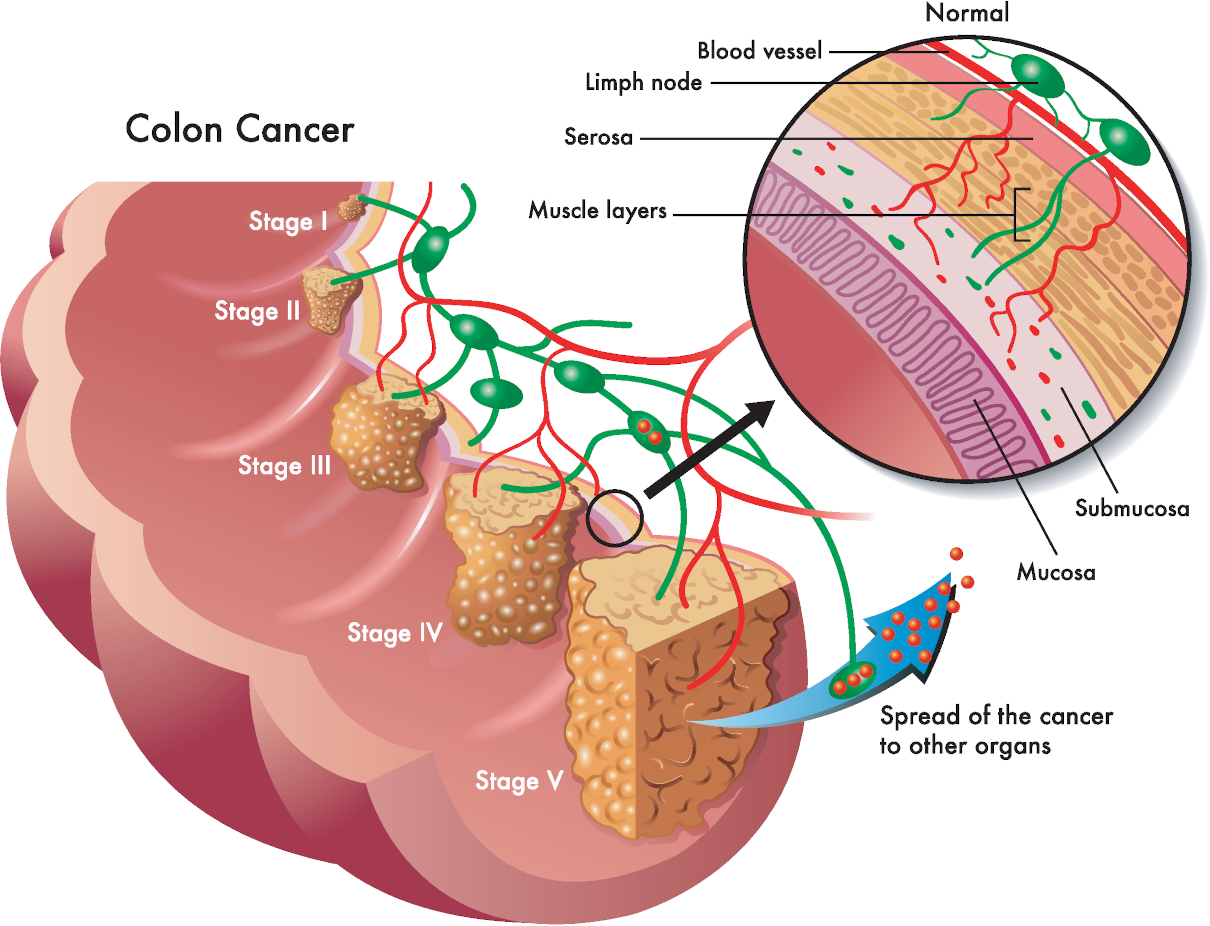 Colonic irrigation - prevention. Fourth stage bowel cancer