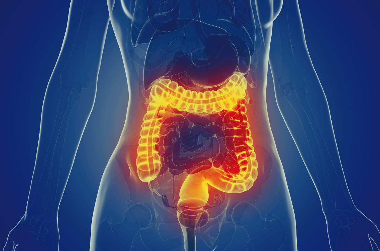 What is the symptom of bowel cancer? Colonic irrigation prevents candidiasis of the intestine