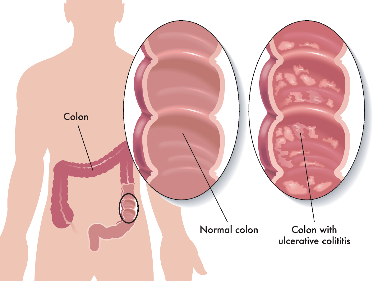 Colitis of the intestine will no longer be a problem