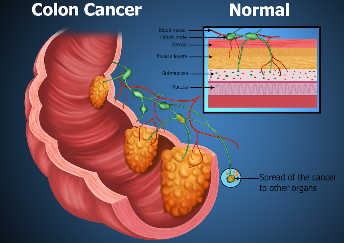 Stool test for bowel cancer. polyps oncology. Good bacteria in our digestive system and intestinal tract. Symptoms