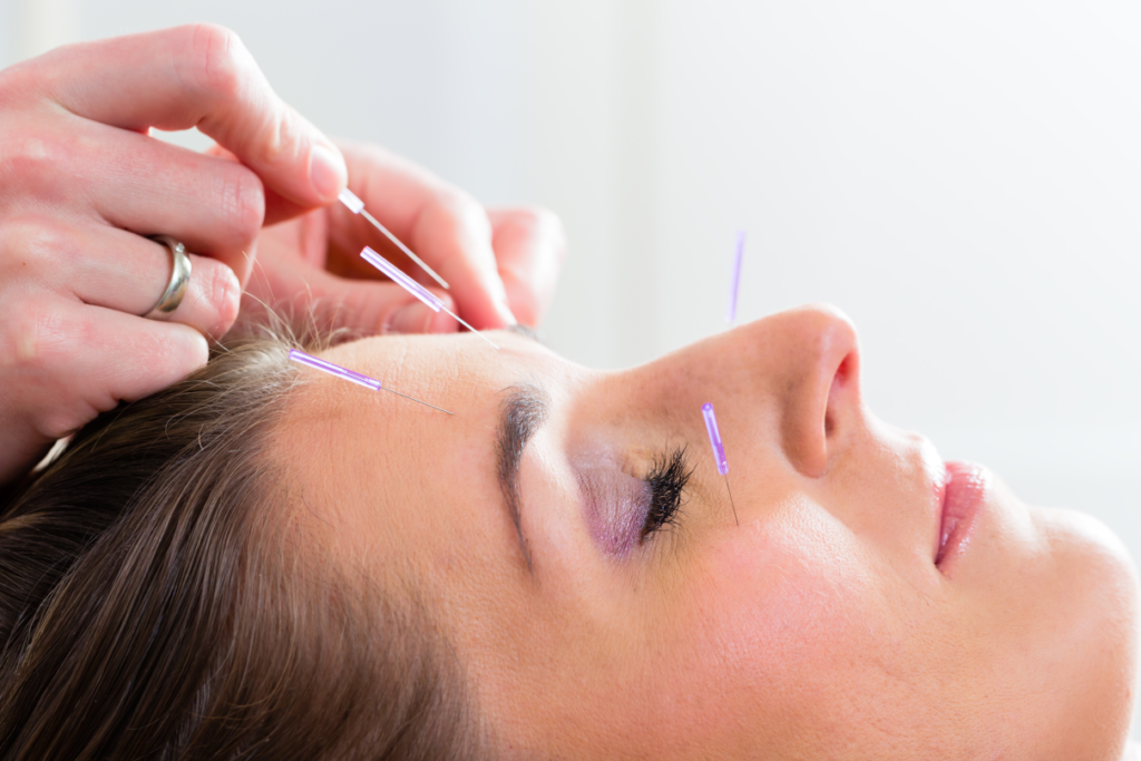 Acupuncture treatment - 30 minutes
