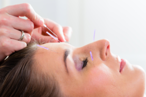 Acupuncture single treatment