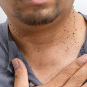 Electrolysis for skin disorders/blemishes