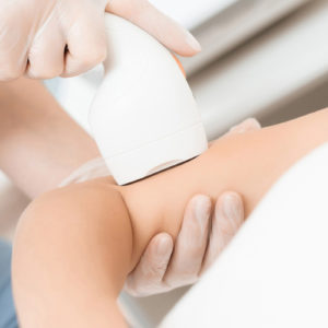 Full Arm Laser Hair Removal