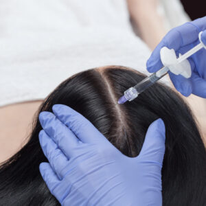 Mesotherapy for Hair loss - six sessions
