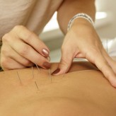 Acupuncture treatment - 1 hour
