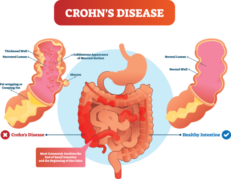 Colonic irrigation contraindications and suitability screening in London