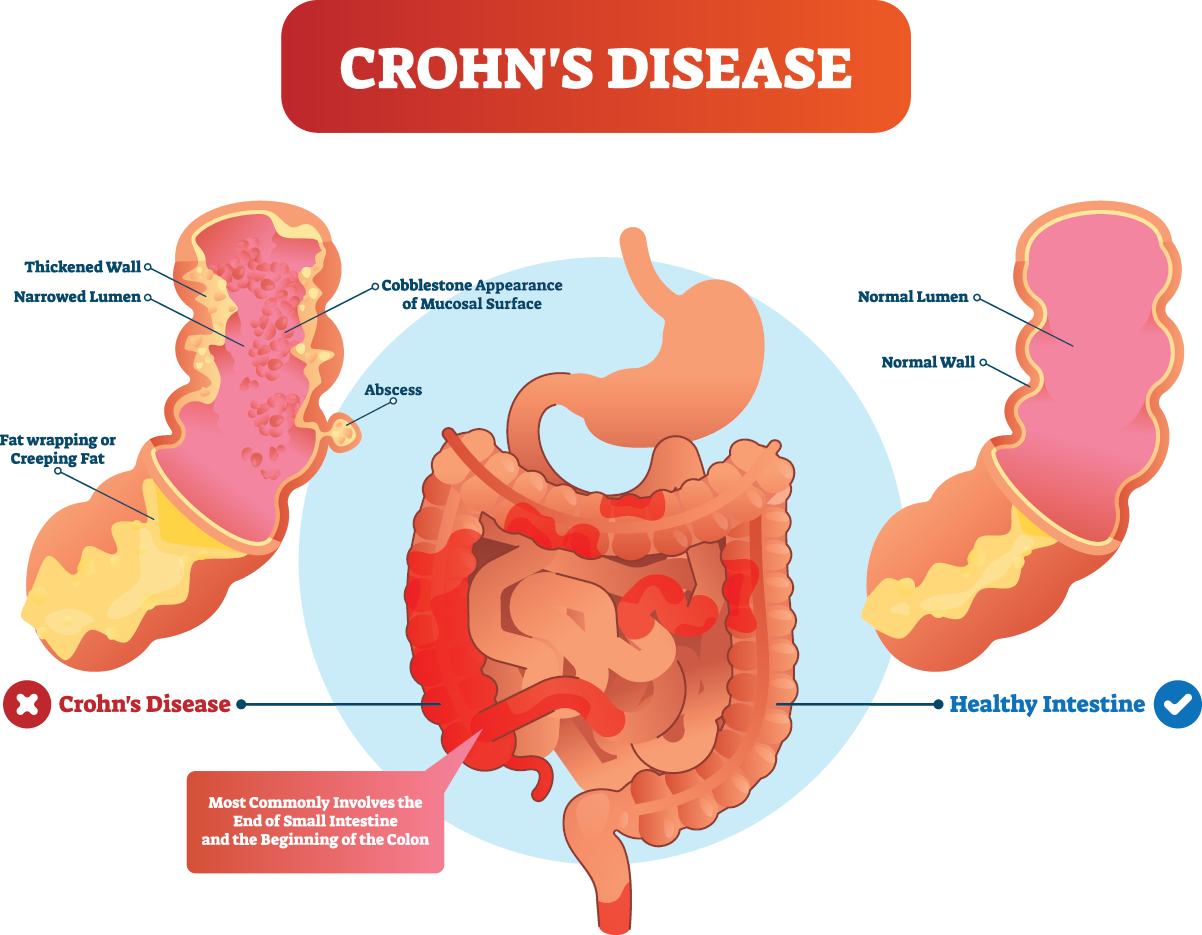 Crohn S Disease Cancer Crohn s Disease Symptoms Causes Treatment 