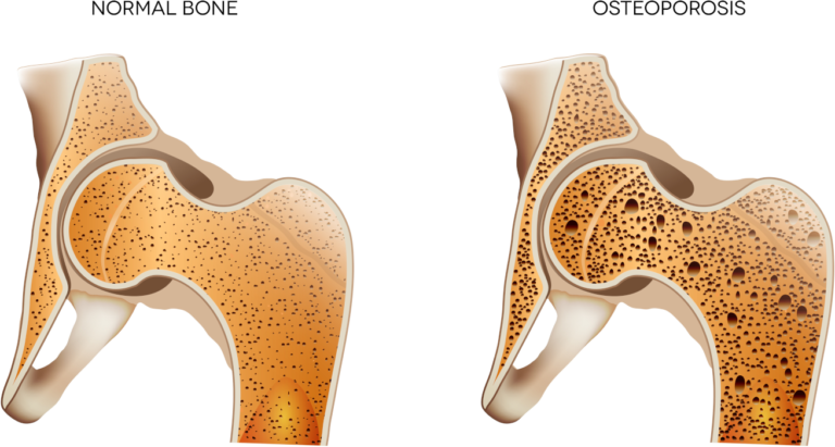 Osteoporosis