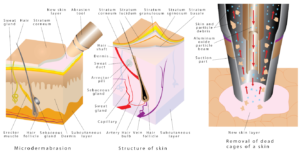Microdermabrasion Diamond treatment restrictions - Ageing Skin