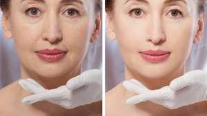 Dermal fillers for aesthetic beauty treatments. Naso-labial folds with dermal fillers