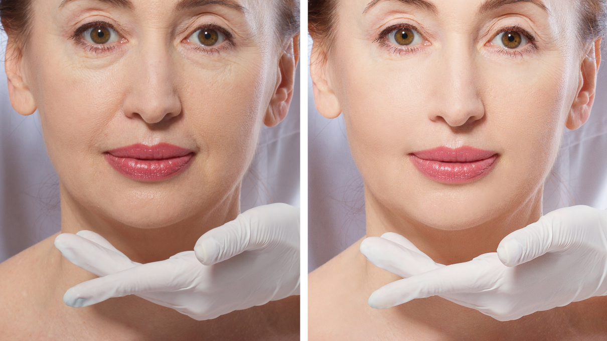 Dermal fillers for aesthetic beauty treatments. Naso-labial folds with dermal fillers