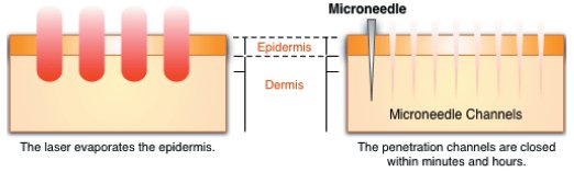 MICRONEEDLE skin THERAPY