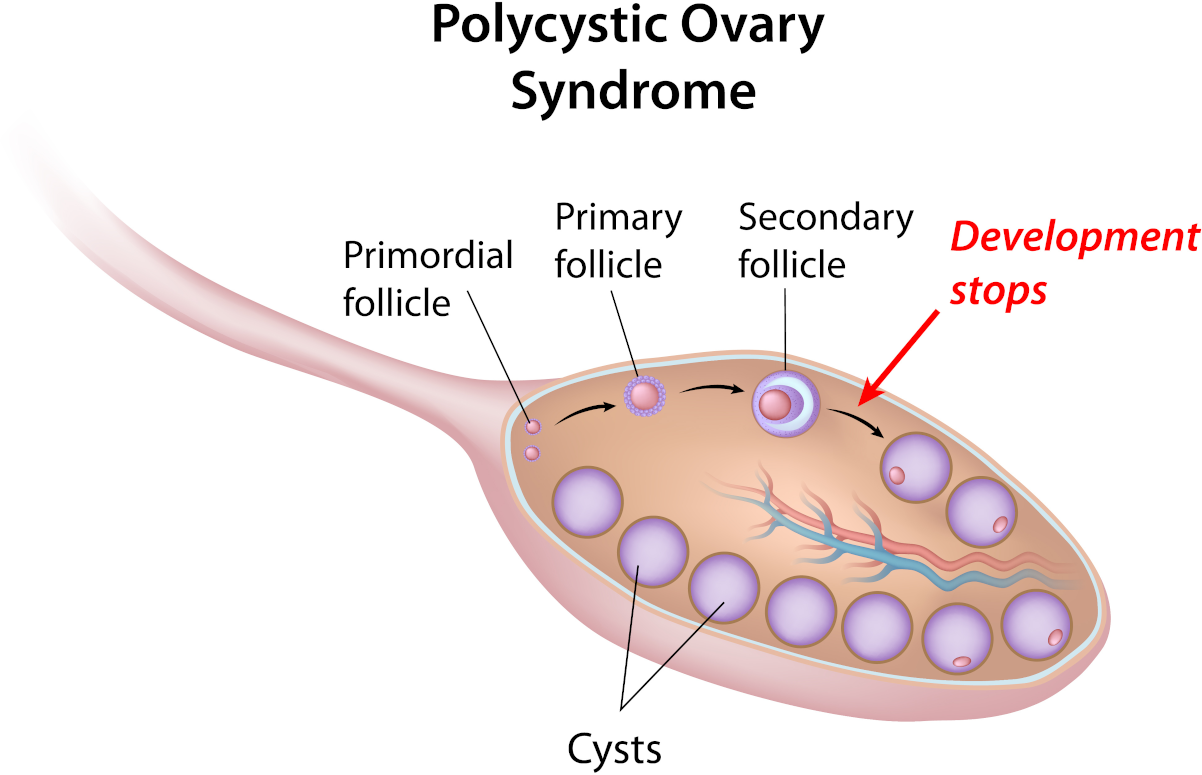 What causes Polycystic ovary syndrome?