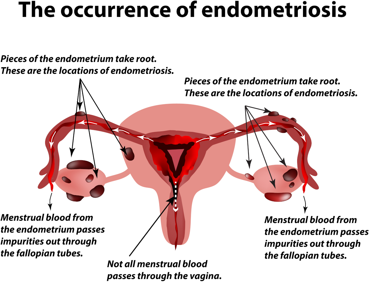 Endometriosis and What Causes It