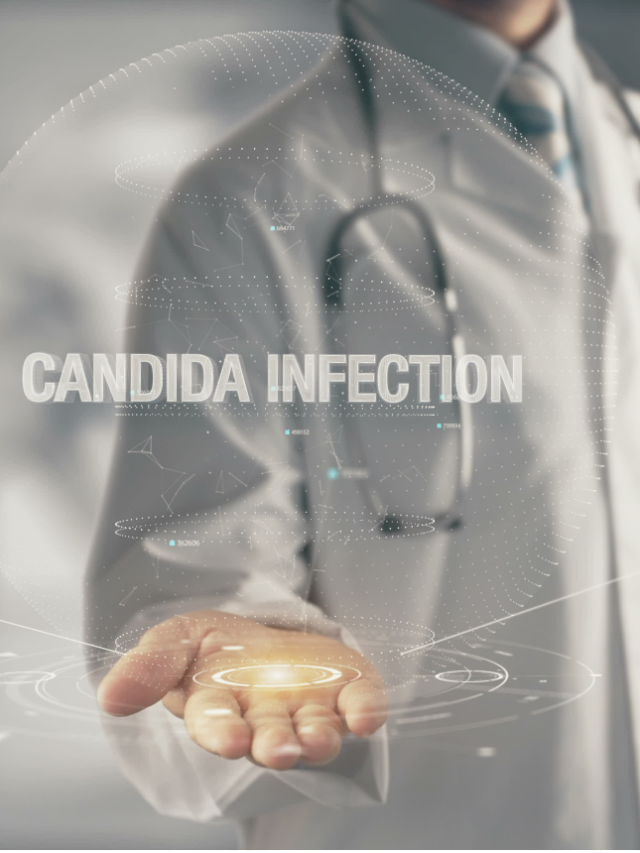 Candida ifection treatment at Parkland